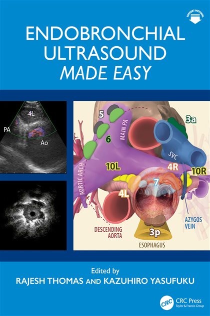 Endobronchial Ultrasound Made Easy, Rajesh Thomas, 9781040389973, 9780367630751, 9781040390016, 978-1040389973, 978-0367630751, 978-1040390016